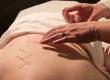 Acupuncture & Menopause