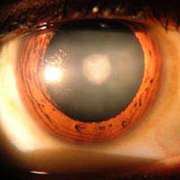 Cataracts Risk Menopause Postmenopausal